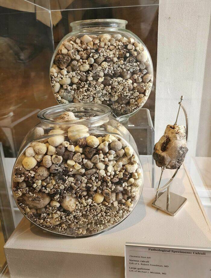 Name:  Dall and kidney stones..jpg
Views: 6087
Size:  123.4 KB